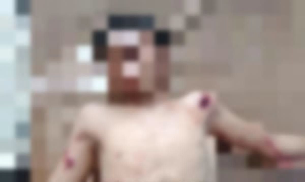 الحديدة.. إصابة طفل بجروح خطيرة جراء انفجار لغم زرعته مليشيا الحوثي شمالي حيس