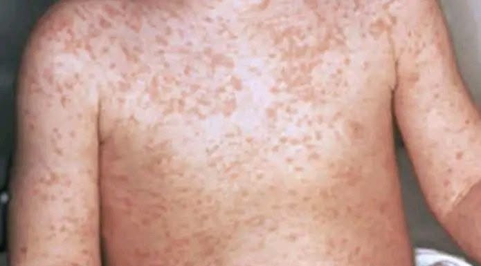 الصحة العالمية تحذّر من تفشي الكوليرا والحصبة في أوساط النازحين باليمن